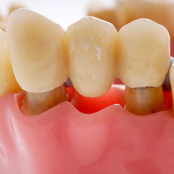 Dental Bridges | Health Plus Dental