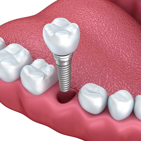 Dental Implants | Health Plus Dental