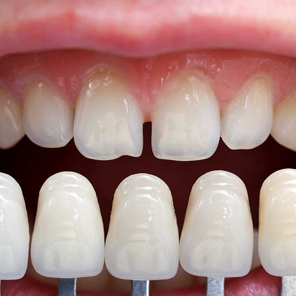 Porcelain Veneers | Health Plus Dental