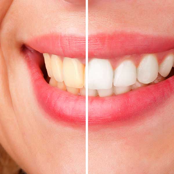 Teeth Whitening | Health Plus Dental