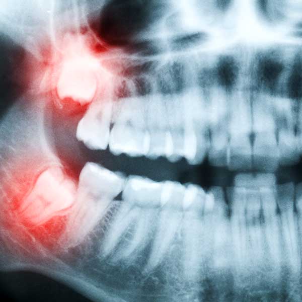 Wisdom Teeth Extractions | Tooth Extractions | Health Plus Dental